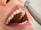 Teeth Cleaning Scaling
